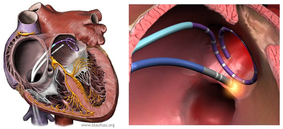 How Effective Is Ablation For Treating Atrial Fibrillation?