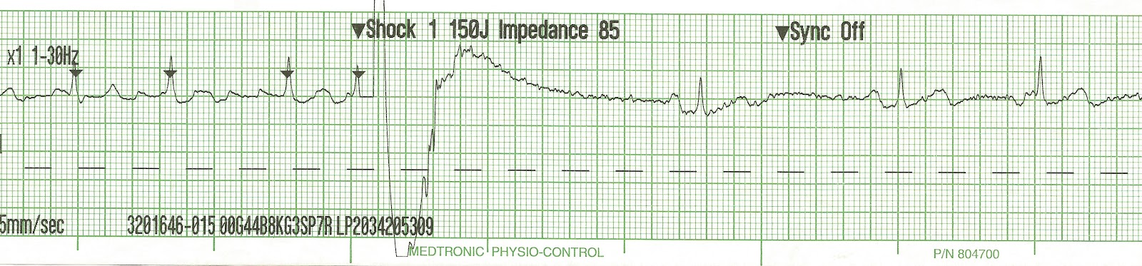 Direct Current Cardioversion