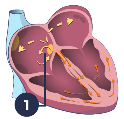 Tachycardia due to AVNRT