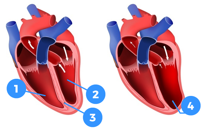 Højre hjertekammer_Venstre hjertekammer_Skillevæg mellem hjertekamre_Forstørret venstre hjertekammer