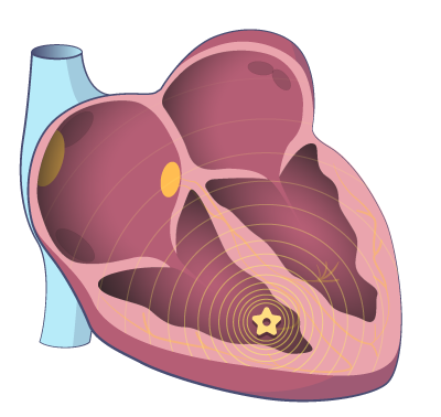 Ventricular tachycardia (VT)