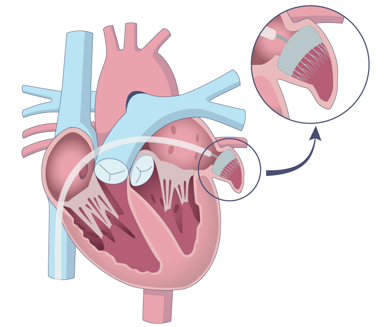lukke venstre forkammers hjerteøre (Aurikellukning)