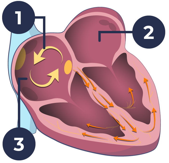 What Is An Atrial Flutter?
