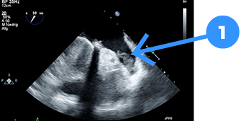 Trombe (pilen) i venstre forkammers "hjerteøre" (aurikel)  